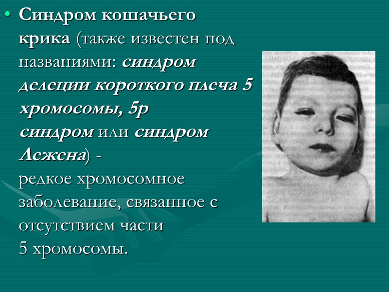 Синдром кошачьего крика (также известен под названиями: синдром делеции короткого плеча 5 хромосомы, 5р